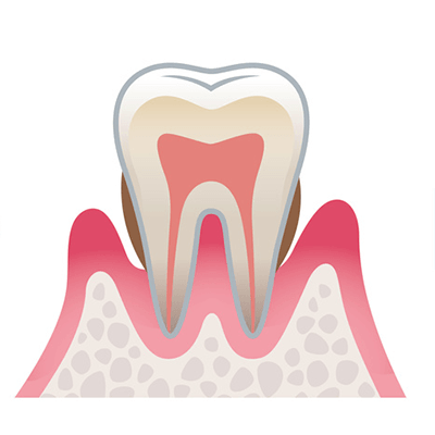 中等度の歯