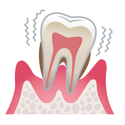 重度の歯